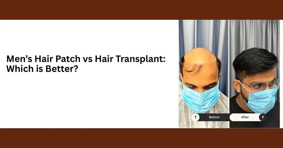 hair patch vs hair transplant